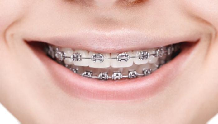 What Kind of Candy Can You Eat with Braces?